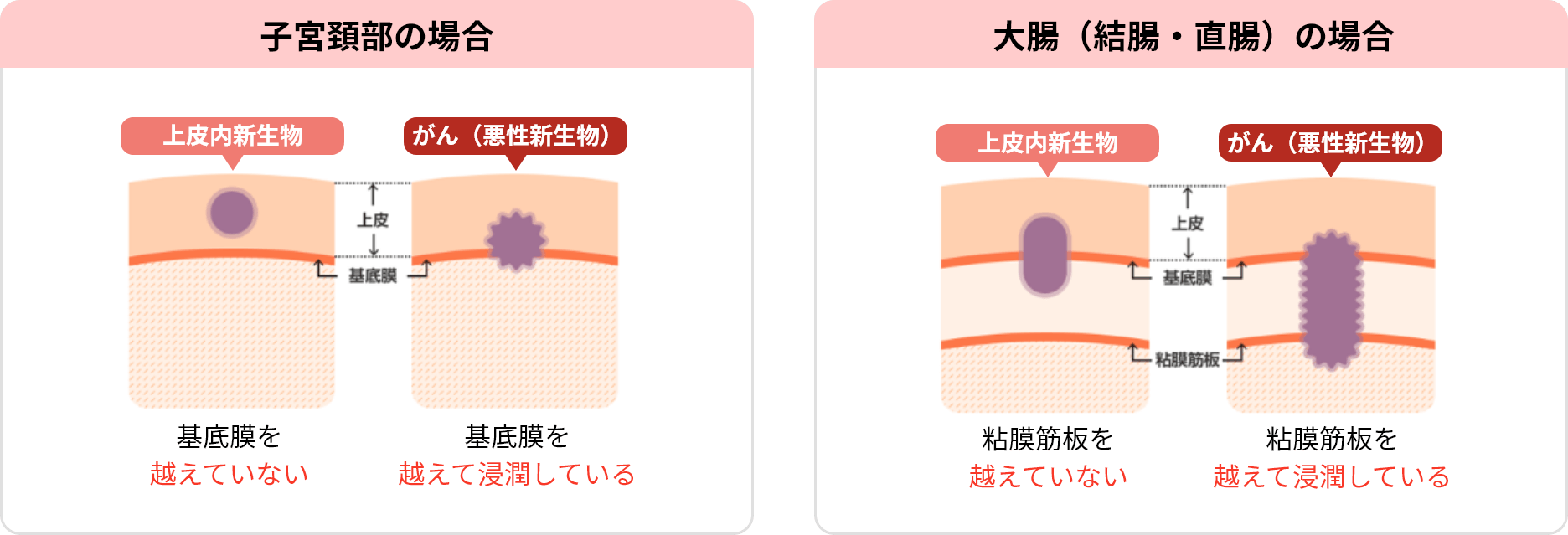 上皮内新生物とがん（悪性新生物）のイメージ