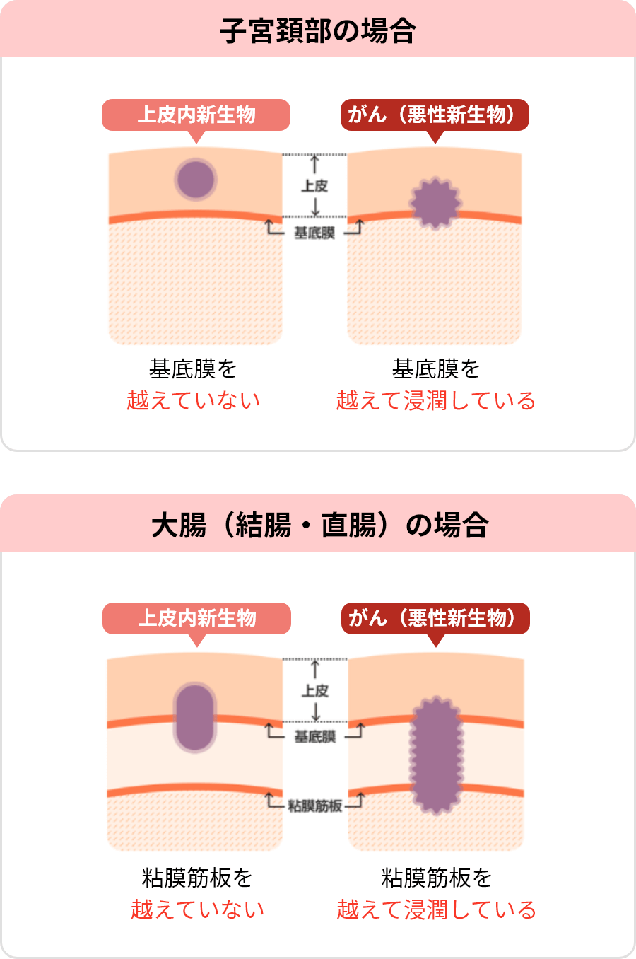 上皮内新生物とがん（悪性新生物）のイメージ